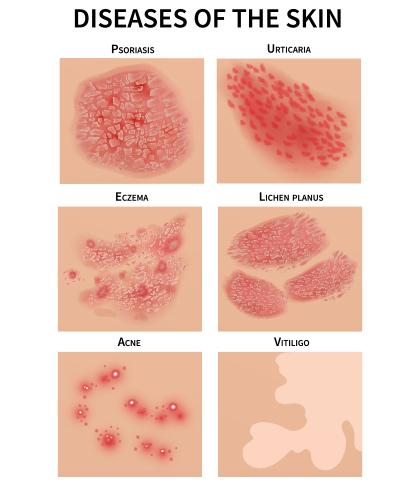 Eczema Vs Psoriasis — Know The Difference. | Dr Batra’s™